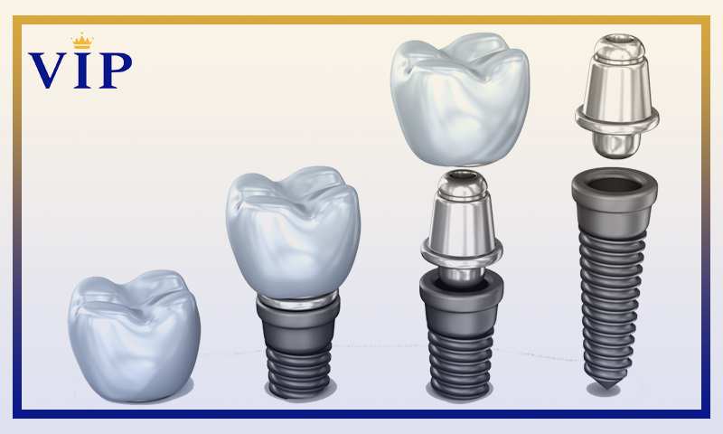 ساختار ایمپلنت دندان